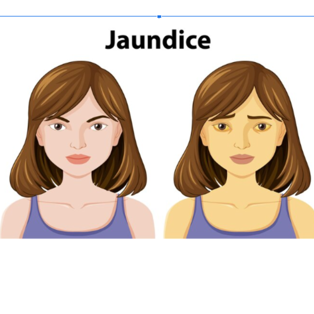 Ayurvedic Treatment Types of jaundice  Dr. Sharda Ayurveda