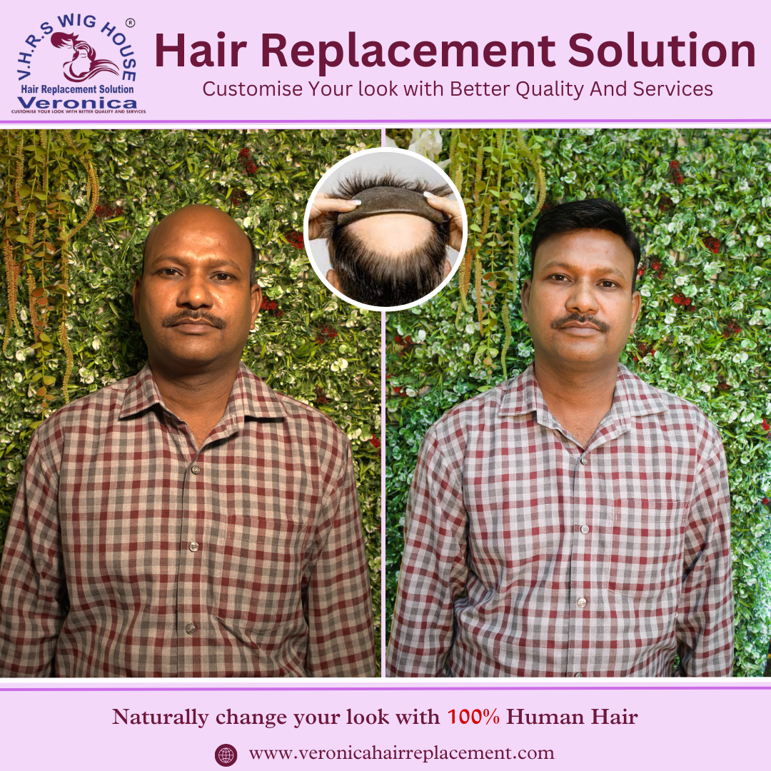 Non-Surgical hair wigs fixing in Rajouri Gardan | Best Hair Patch Fixing & Hair Wigs Fixing