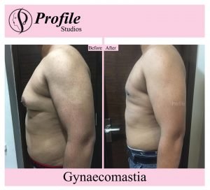 Best Gynecomastia Surgery in Ludhiana – Safe, Affordable, and Effective