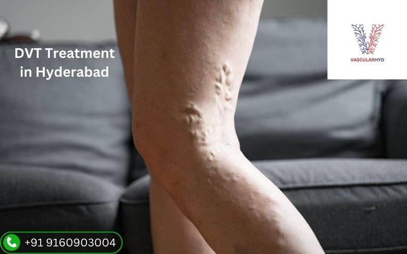 Deep Vein Thrombosis Treatment in Hyderabad