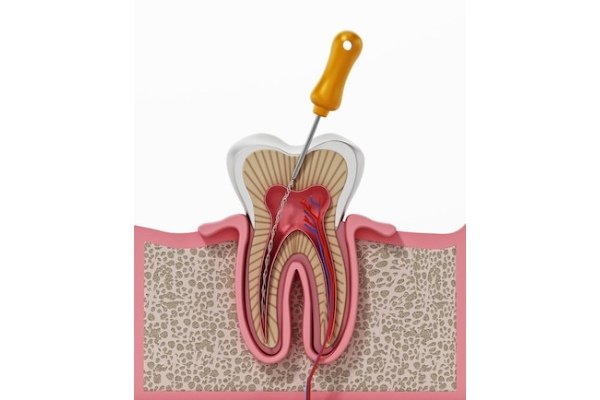 Root Canal Treatment In Gurugram