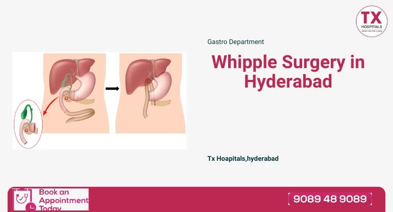 Whipple Surgery in Hyderabad -TX Hospitals