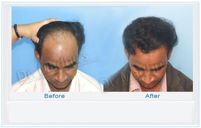 Best Hair Transplant Doctor in Jubilee Hills, Hyderabad Dr. Ram | Hairhospi